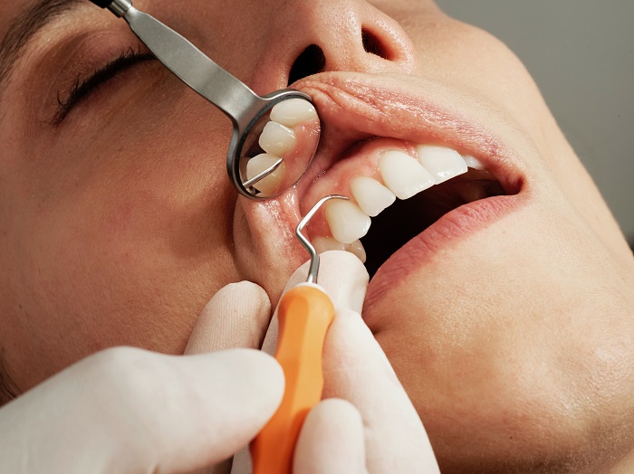 Benefits Of Dental Implants